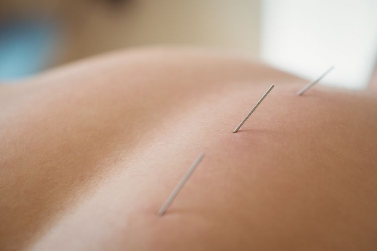 Akupunktur - Arztpraxis Dr. Thomas Jurgan | Bonn & Köln